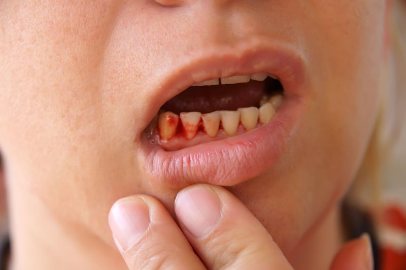 Sưng lợi - chảy máu chân răng ở trẻ em