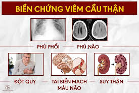 Xét nghiệm viêm cầu thận cần được tiến hành thường xuyên không? Tần suất xét nghiệm như thế nào là phù hợp?
