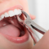 Cần lưu ý những gì trước và sau khi nhổ răng khôn?